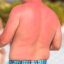 Prednosti i štete od sunčanja za tijelo